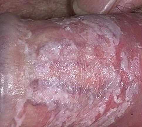 Curdled discharge on excitement
